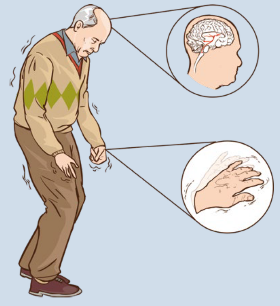 Choroba Parkinsona a fizjoterapia