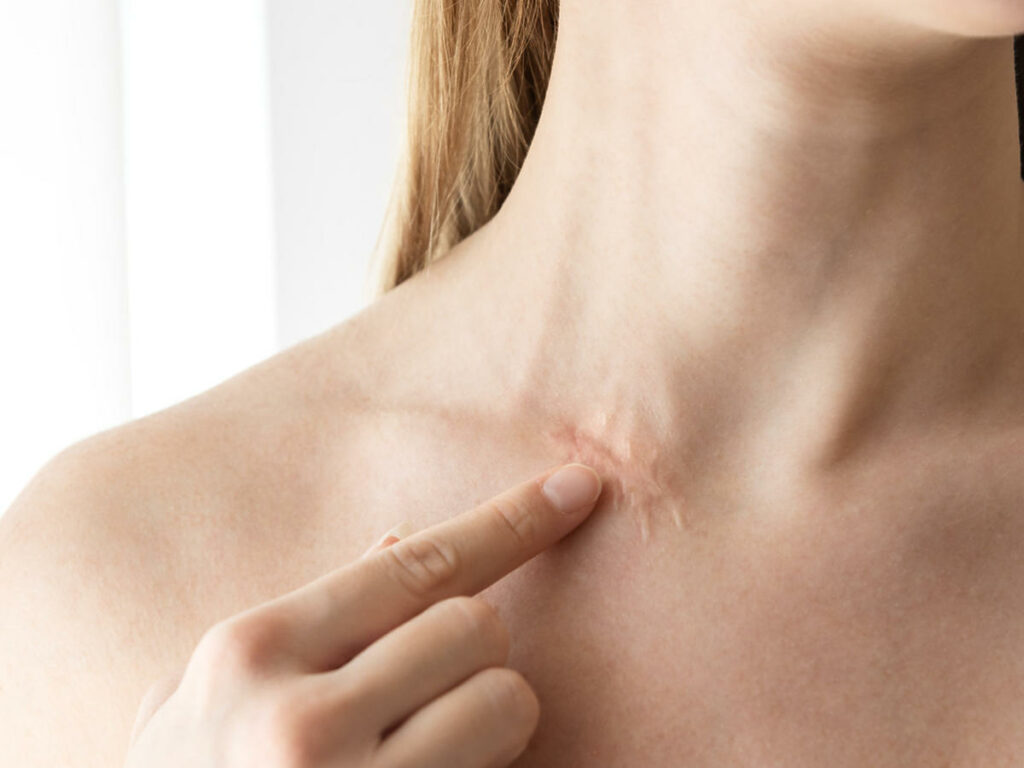 Fizjoterapia w leczeniu blizn i bliznowców