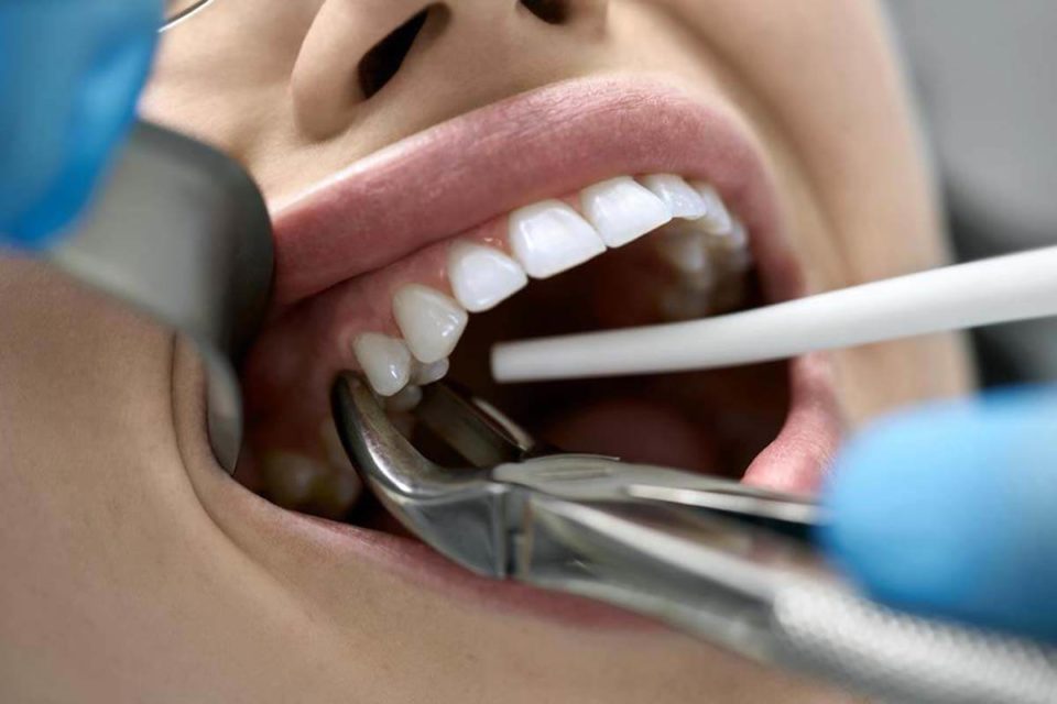 Chirurgiczne usuwanie zębów mądrości