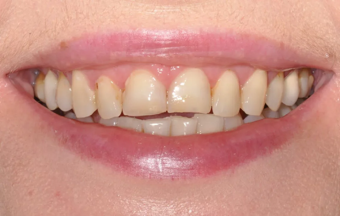 Odbudowa startych zębów - metody