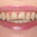 Odbudowa startych zębów - metody