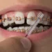 ortodoncja-tradycyjne metody ortodontyczne