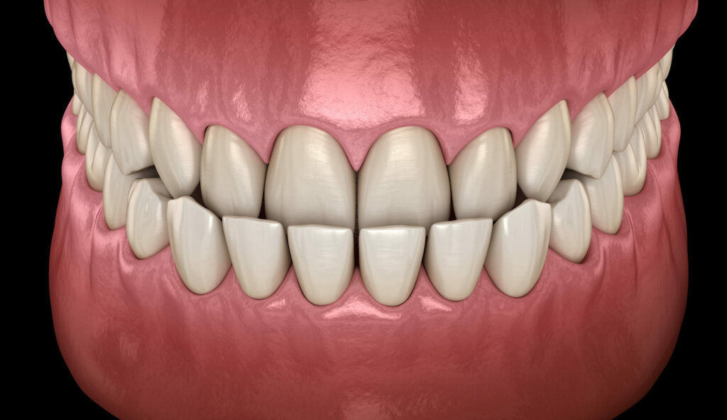 Ortotropia a leczenie wad zgryzu